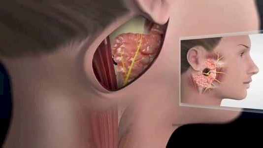 تشبه الانفلونزا .. اكتشف أعراض غدة النكاف