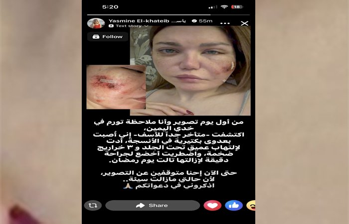 جراحة دقيقة .. ياسمين الخطيب تعلن إصابتها بعدوى بكتيرية في أنسجة بشرة الوجه