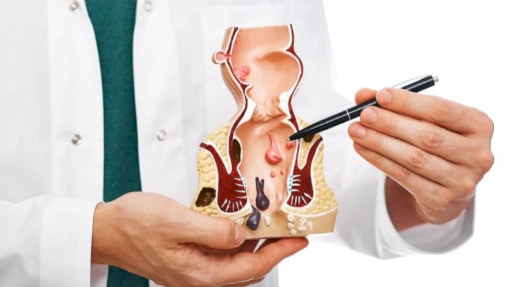 تسبب متاعب متعددة .. اكتشف أسباب البواسير ومضاعفاتها